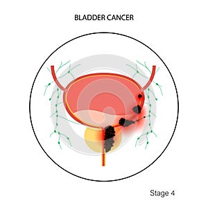 Bladder cancer stages