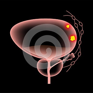 Bladder cancer stages