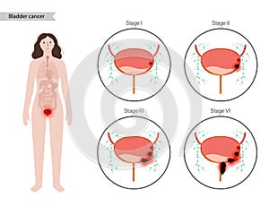 Bladder cancer stages