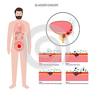 Bladder cancer stages