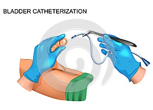 Bladder catheterization for men