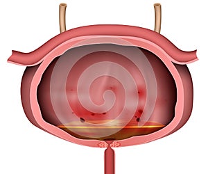 Bladder inflammation 3d vector illustration unlabeled on white background