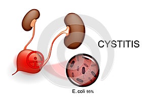 Bladder and kidneys. cystitis