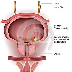 Bladder stones 3d medical illustration on white background