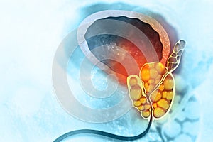 Bladder stones. Cross section
