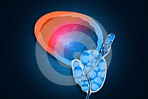 Bladder stones. Cross section