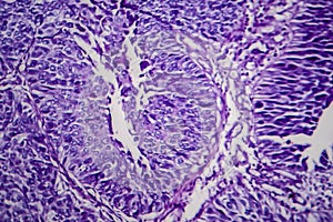 Bladder transitional cell carcinoma, light micrograph