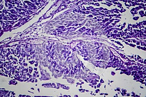 Bladder transitional cell carcinoma, light micrograph