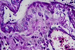 Bladder transitional cell carcinoma, light micrograph