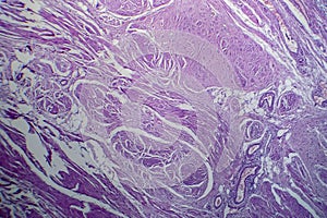 Bladder transitional cell carcinoma, light micrograph