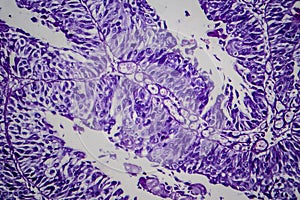 Bladder transitional cell carcinoma, light micrograph