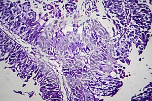 Bladder transitional cell carcinoma, light micrograph