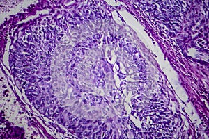 Bladder transitional cell carcinoma, light micrograph