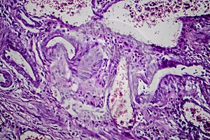 Bladder transitional cell carcinoma, light micrograph