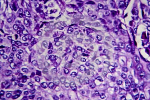 Bladder transitional cell carcinoma, light micrograph