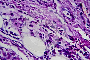 Bladder transitional cell carcinoma, light micrograph