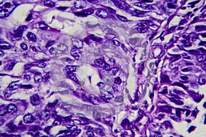 Bladder transitional cell carcinoma, light micrograph