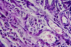 Bladder transitional cell carcinoma, light micrograph