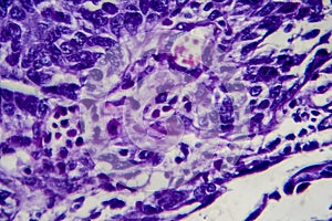Bladder transitional cell carcinoma, light micrograph