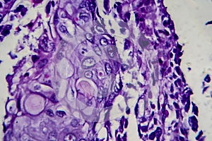 Bladder transitional cell carcinoma, light micrograph