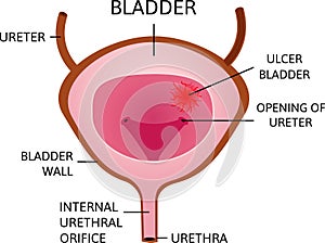 Bladder ulcer. Red and oval ucler inside the bladder caviry. Desease. Strong pain. photo