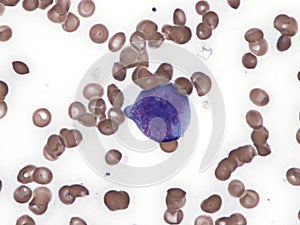 Blast cell in acute myeloid leukemia.