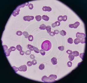 Blast cell on blood smear.