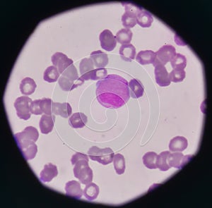 Blast cell on blood smear.
