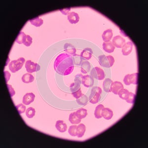Blast cell on blood smear.