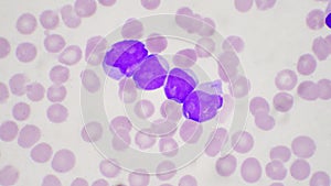 Blast cell in leukemia pateins in blood smear photo