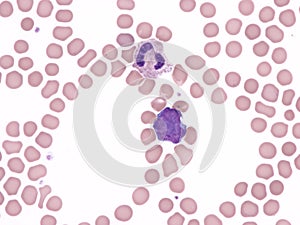 Blast cell in peripheral blood (Natalizumab).