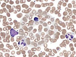 Blast cell in peripheral blood (Natalizumab).