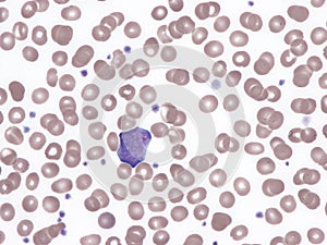 Blast cell in peripheral blood (Natalizumab).