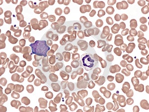 Blast cell in peripheral blood (Natalizumab).
