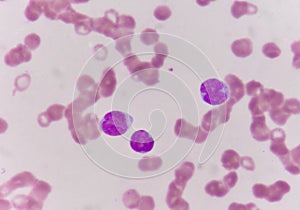 Blast cells in blood smear.