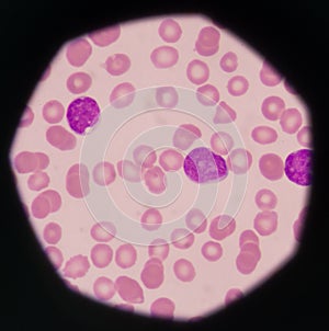 Blast cells in peripheral blood images. photo