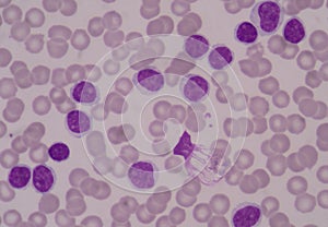 Blast cells on red blood cells .