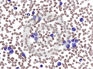 Blast phase of essential thrombocythemia.