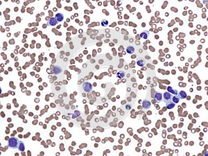 Blast phase of essential thrombocythemia.