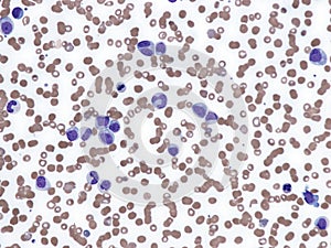 Blast phase of essential thrombocythemia.