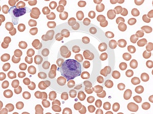 Blastoid mantle cell lymphoma in peripheral blood.