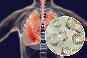 Blastomyces dermatitidis infection of lungs