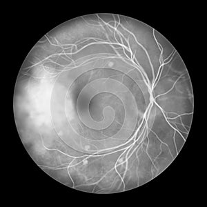 A blastomycosis-affected retina as seen during ophthalmoscopy, illustration