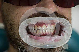 Bleaching of the teeth at dentist clinic. Administer anesthetics to keep patients from feeling pain during procedures photo