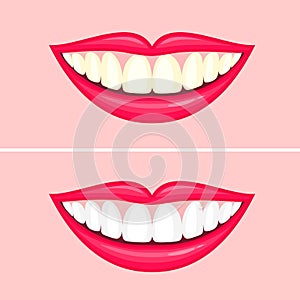 Bleaching teeth treatment. Whiten teeth before and after.