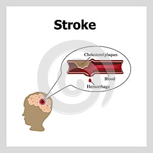 Bleeding in the brain. Insult. Stroke, atherosclerosis. Cholesterol plaques. Infographics. Vector illustration photo