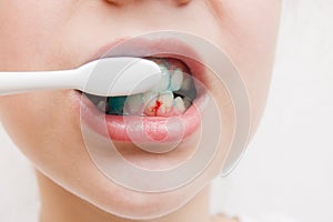 Bleeding at teeth during brushing with toothbrush.bleeding gums