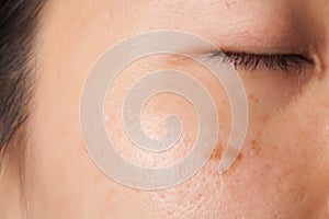 Blemish and spots photo