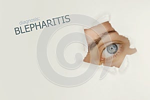 Blepharitis disease poster with blue eye on right. photo