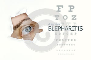 Blepharitis disease poster with eye test and blue eye on left photo
